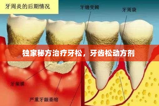 独家秘方治疗牙松，牙齿松动方剂 